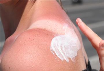 Eine Frau trägt Creme auf einen Sonnenbrand auf.  Am Strand weggedöst oder stundenlang im Garten gearbeitet - ohne genug Sonnenschutz und Schattenpausen? Das kann mit einem fiesen Sonnenbrand enden. Eine Dermatologin verrät, was der Haut dann guttut.