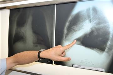 Auf dem Röntgenbild ist eine von Krebs befallene Lunge zu sehen. Die Zahl neuer Krebsdiagnosen wird weltweit enorm steigen.

