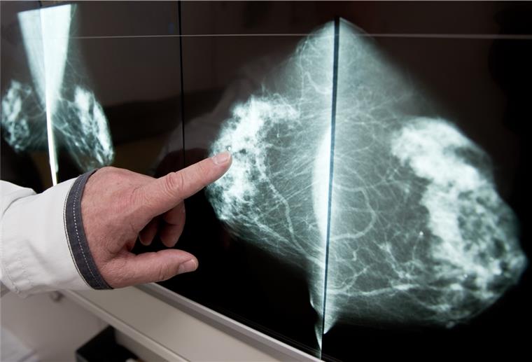 Brustkrebs-Diagnose war für eine Zevenerin ein Schock Beim Mammographie-Screening werden schon frühzeitig Veränderungen in der Brust, wie hier eine gutartige Fettzellen-Verkalkung, erkannt.