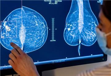 Ein Arzt schaut auf eine Mammografie
