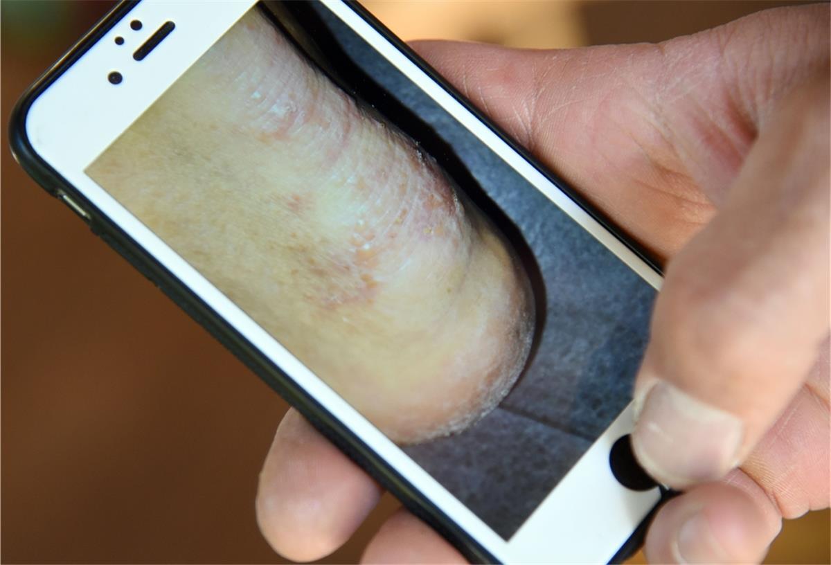 Ein Mann zeigt auf einem Smartphone ein Foto seines von Krätze befallenen Fußes. Derzeit gibt es in der Seestadt Bremerhaven vermehrt Fälle der durch Skabiesmilben verursachten Erkrankung. 
