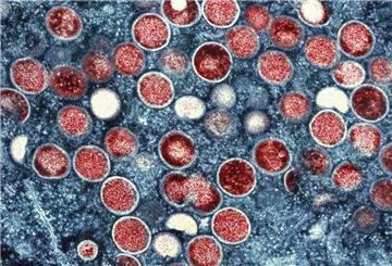 In Deutschland wurde erstmals die neue Mpox-Variante Klade Ib bestätigt. Laut RKI besteht keine erhöhte Gefahr.