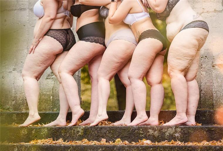 Frauen mit Lipödem-Erkrankung. Betroffene kämpfen für eine Ent-Stigmatisierung der Krankheit und fordern mehr kompetente Ärzte.