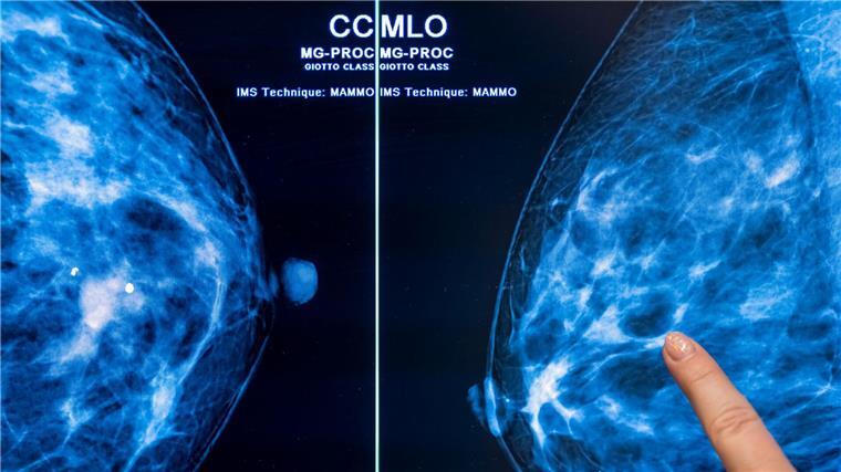 IN Niedersachsen erkranken nach Daten der Kaufmännischen Krankenkasse KKH mehr Frauen an Brustkrebs. (Symbolbild)