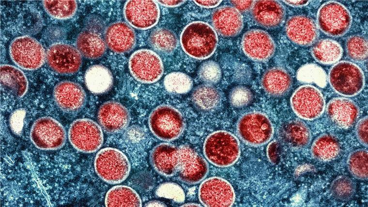 Gesundheitsminister über Mpox: „Sind gut aufgestellt“ Mpox Klade IIb wird durch engen Körperkontakt übertragen, vor allem beim Sex. (Archivbild)