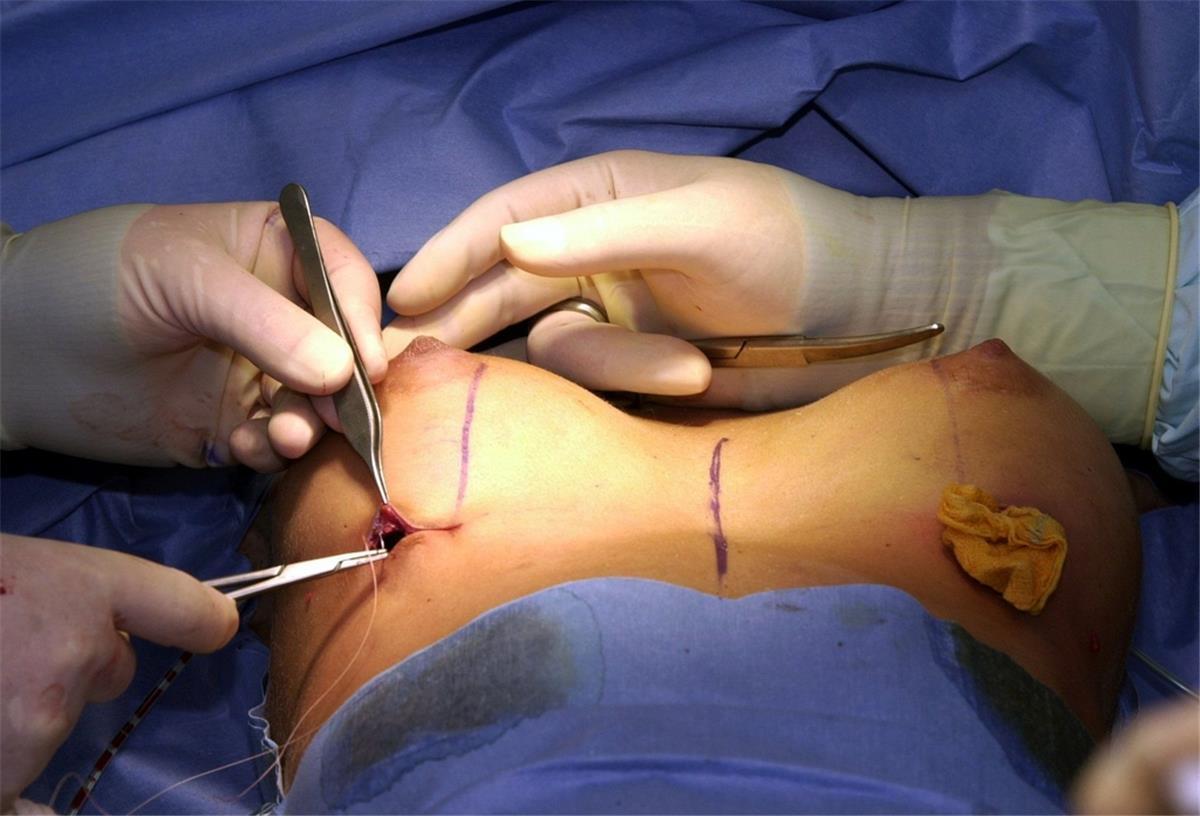 Celle: Kein Geld für Brustvergrößerung aus psychischen Gründen Bei einer Brustvergrößerung wird nach dem Einsetzen eines Silikon-Implantats der Schnitt zugenäht.