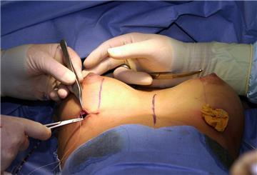 Bei einer Brustvergrößerung wird nach dem Einsetzen eines Silikon-Implantats der Schnitt zugenäht.