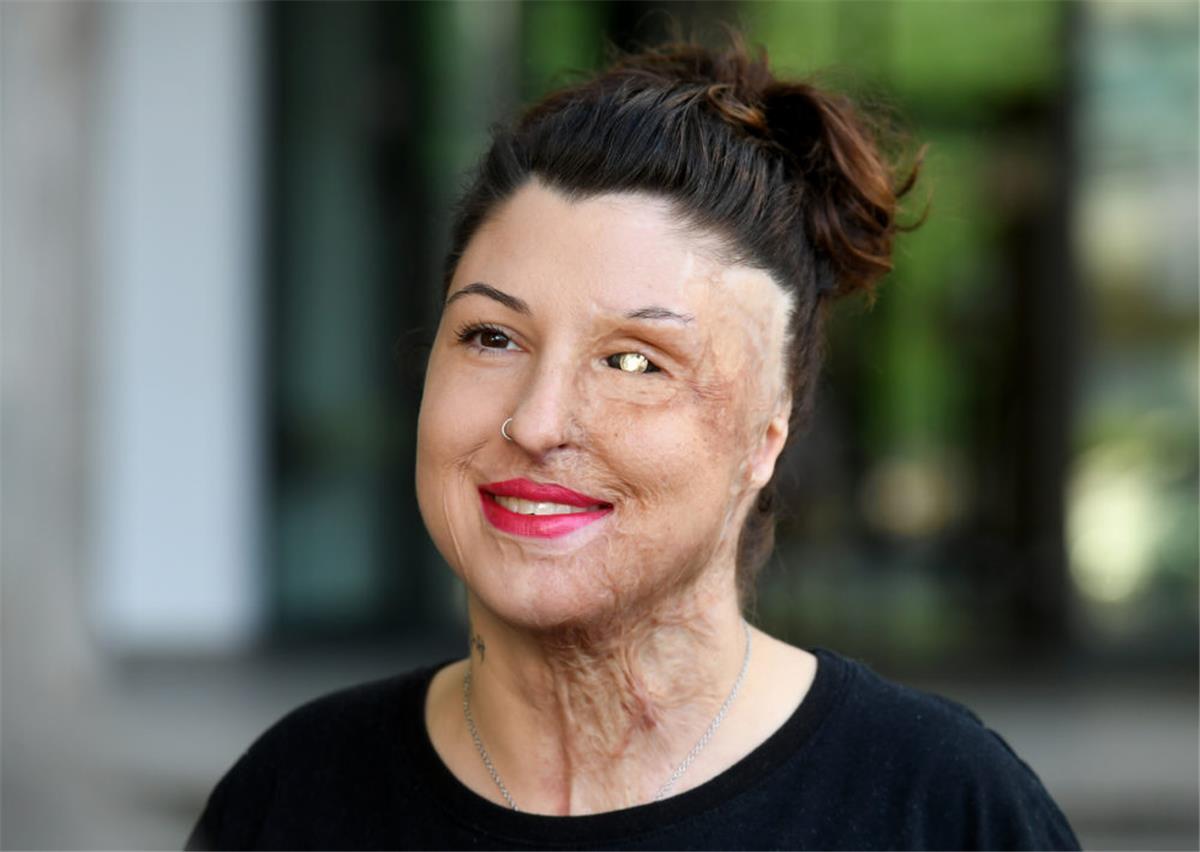 Nach Säure-Anschlag: Vanessa Münstermann heiratet Jugendliebe Vanessa Münstermann, Opfer eines Säure-Anschlags, hat geheiratet.