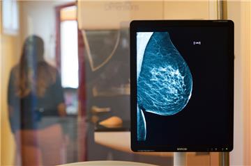 Zur Brustkrebsvorsorge, der Mammografie, gehen in Bremerhaven und Bremen 57 Prozent der bei der AOK versicherten 50 bis 69 Jahre alten Frauen. 